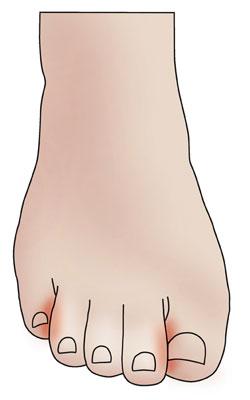 Crooked Big and Pinky Toe