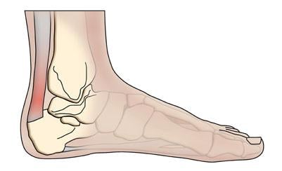 Achilles Tendon Pain - Achilles Tendonitis