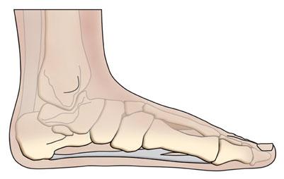 Plantar Fasciitis
